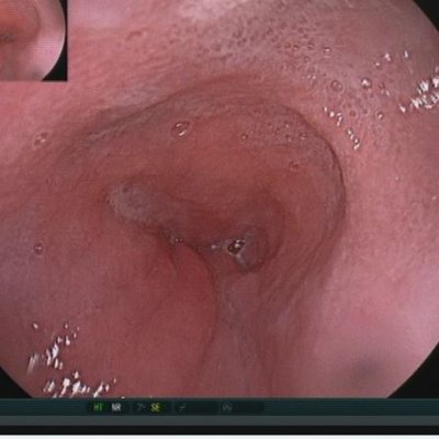 Abb.1: Bild der Achalasie der Speiseröhre bei Gastroskopie