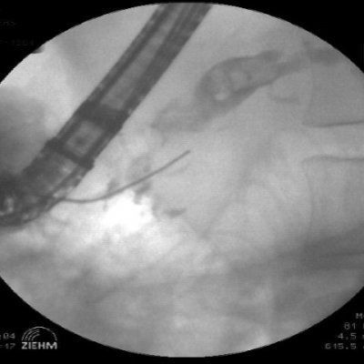 Abb. 1: ERCP - Verengung Bauchspeicheldrüsengang mit Steinbildung