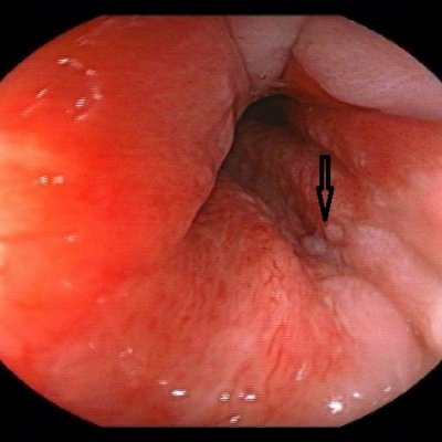 Abb. 1 früh entdeckte Condylome ohne Krebsentwicklung