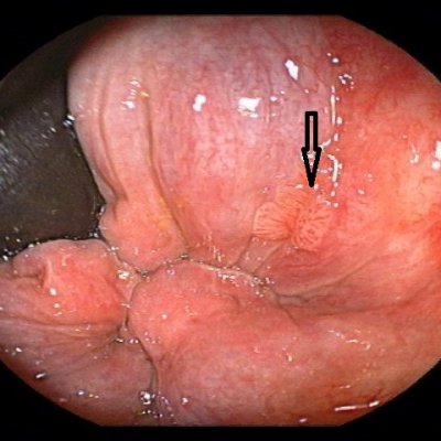 Abb. 2 Condylome kurz vor der Krebsentstehung mit hochgradiger intraepithelialer Neoplasie