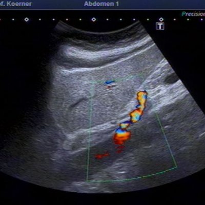 Stenose mit Flussbeschleunigung in Truncus coeliacus