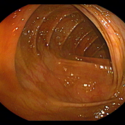 Abb.2: Colitis ulzerosa in Remission nach Therapie