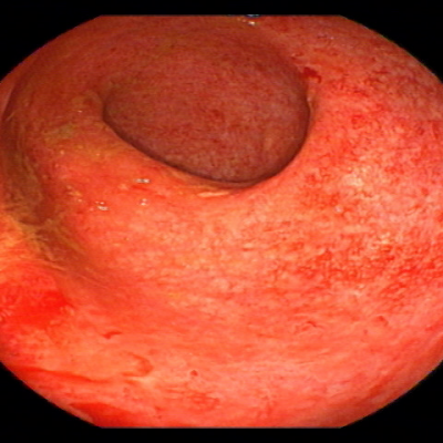 Abb. 1: floride Colitis ulzerosa vor Therapie