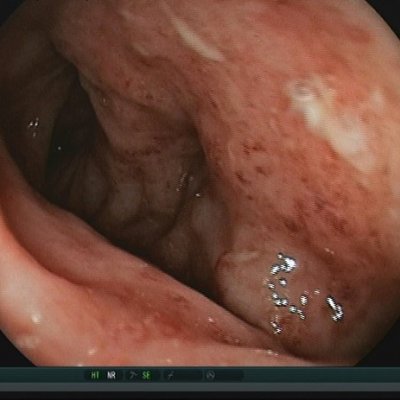 Morbus Crohn Abb. 1