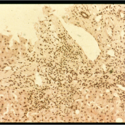 Histologie - Autoimmune Hepatitis