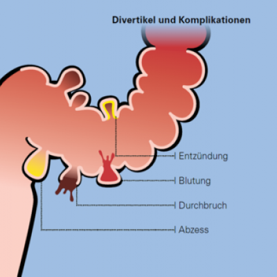 Abb. 4: Schema der Divertikulitis (Divertikelkrankheit) Quelle: Universitätsspital Basel 2017
